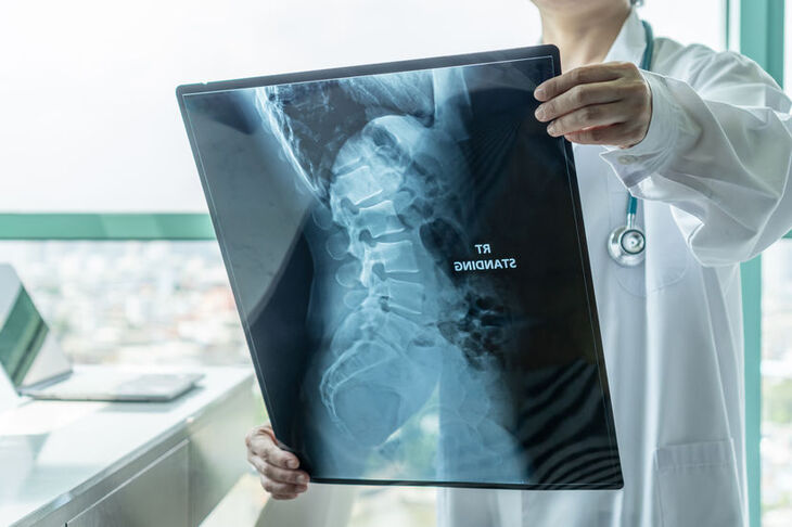 Lekarz ogląda zdjęcie RTG kręgosłupa