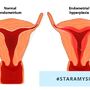 Przerost endometrium