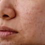 Twarz kobiety z nadmiarem sebum