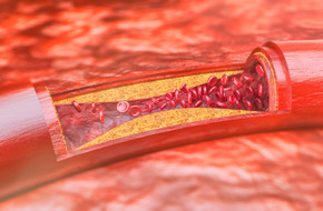 Leczenie wysokiego cholesterolu rozuwastatyną.