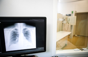 Zdjęcie przedstawia obraz rentgenowski płuc, co sugeruje diagnostykę chorób układu oddechowego, takich jak gruźlica.